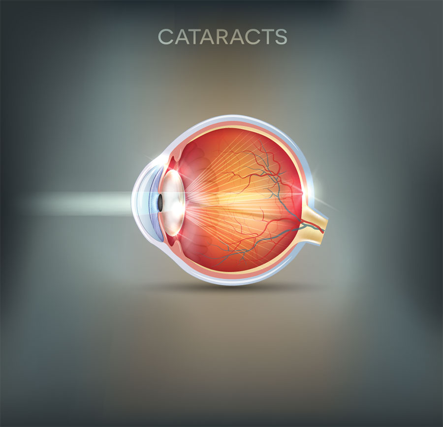 Cataracts, Eye Consition that can be tested at Foley Opticians, Wexford