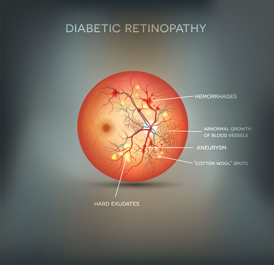 Diabetic Retinopathy, Eye Consition that can be tested at Foley Opticians, Wexford