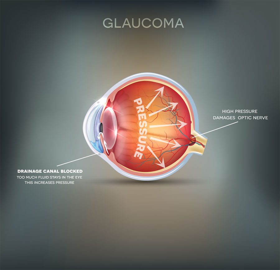 Glaucoma, Eye Consition that can be tested at Foley Opticians, Wexford