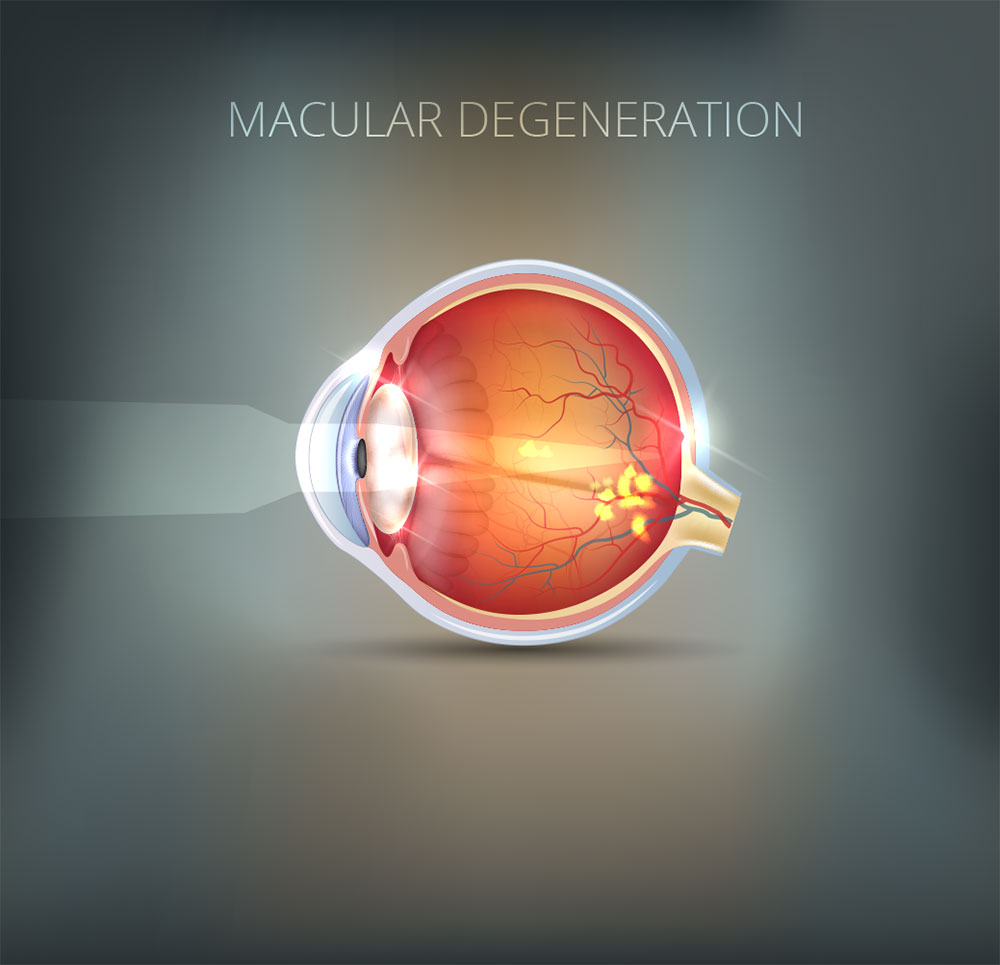 Macular Degeneration Eye condition, eye services, Foley Opticians