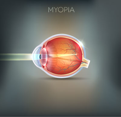 Side profile of an eye with Myopia