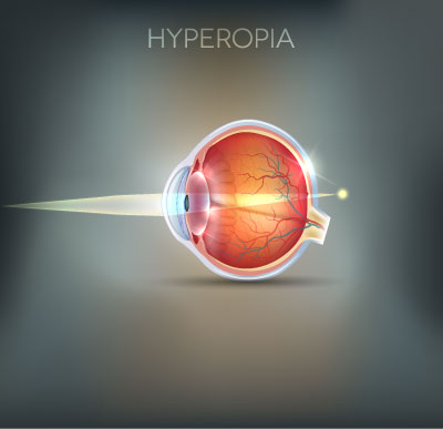 Side profile of an eye with Hyperopia VisionDisorder, Foley Opticians give eye care advice